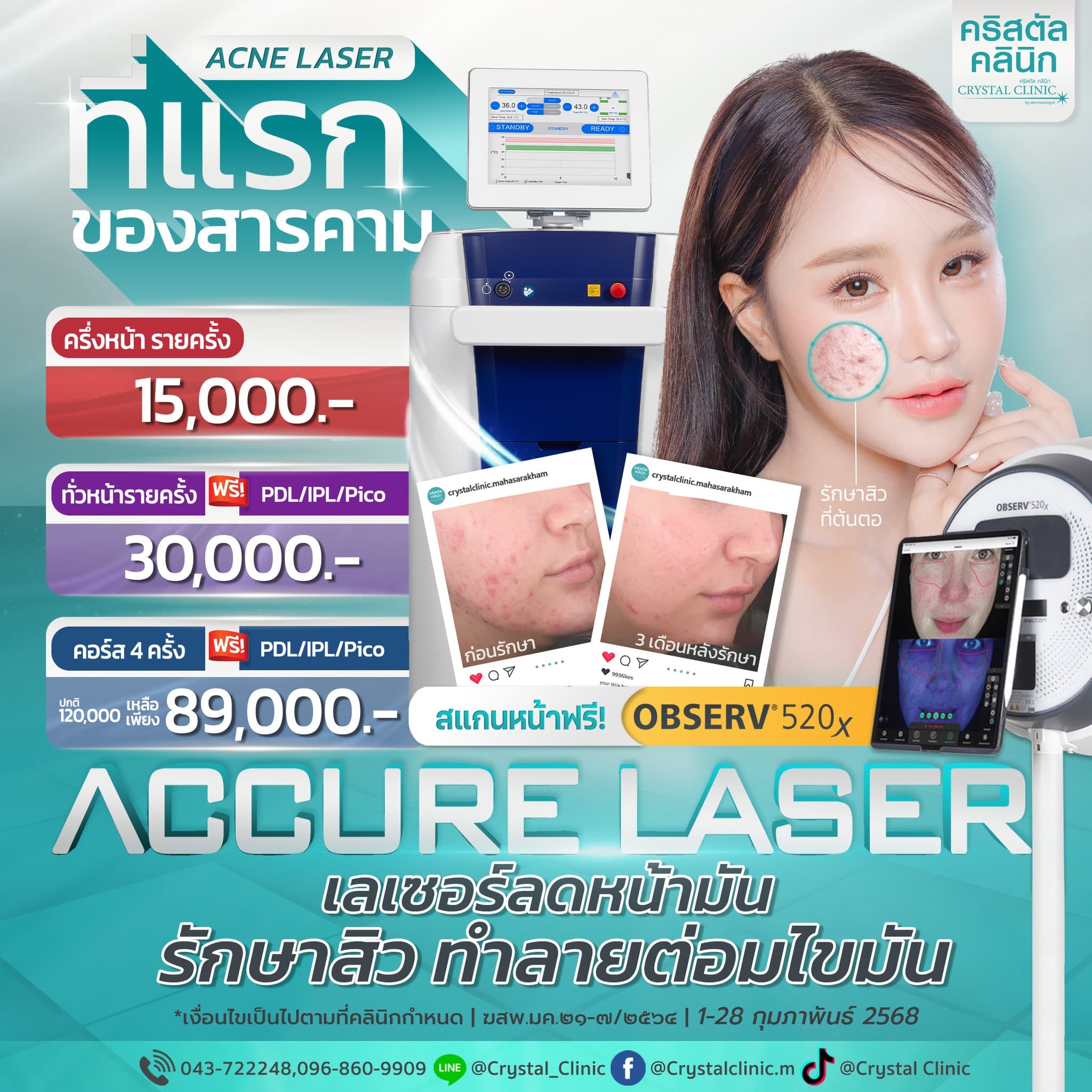 ผลงาน Accure Laser